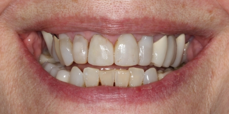 Close up of damaged smile before full mouth reconstruction